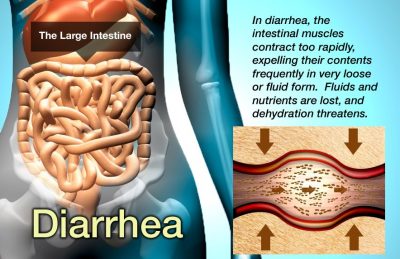 Treatment for Chronic Diarrhea