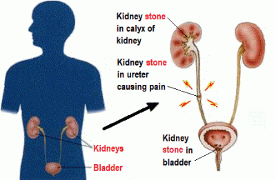 Kidney Stone Pain
