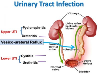 what does a urinary tract infection feel like