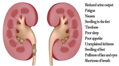 herbs for kidney cleanse