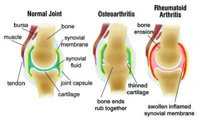 osteoarthritis and rheumatoid arthritis