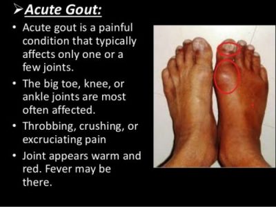 Acute Gout Attack