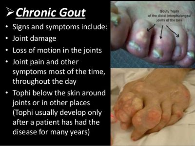 Treatment of Chronic Gout