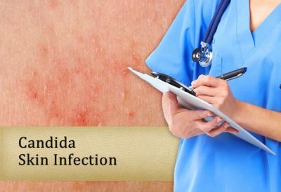 What is Candida